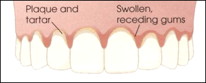 Scaling & Deep Cleaning - Periodontal Therapy - The Brooklyn Dentist