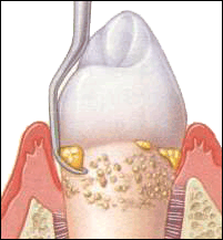 Scaling & Deep Cleaning - Periodontal Therapy - The Brooklyn Dentist